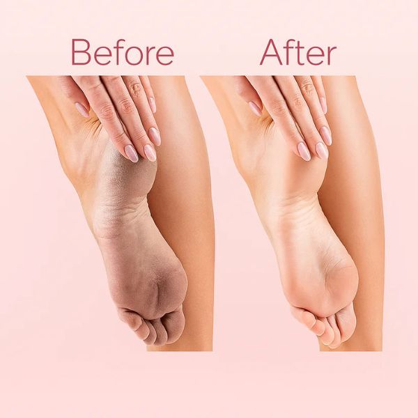 Rechargeable Electric Foot File – Callus Remover & Pedicure Tool for Cracked Heels